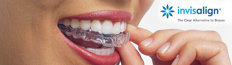 Invisible Braces: Invisalign® in Carmichael, CA - Marconi Dental Group
